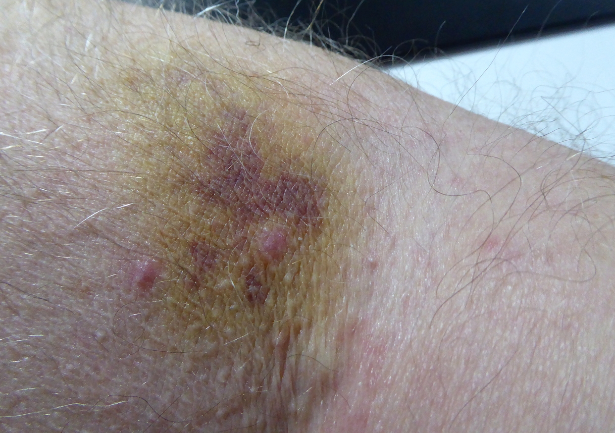 bruise