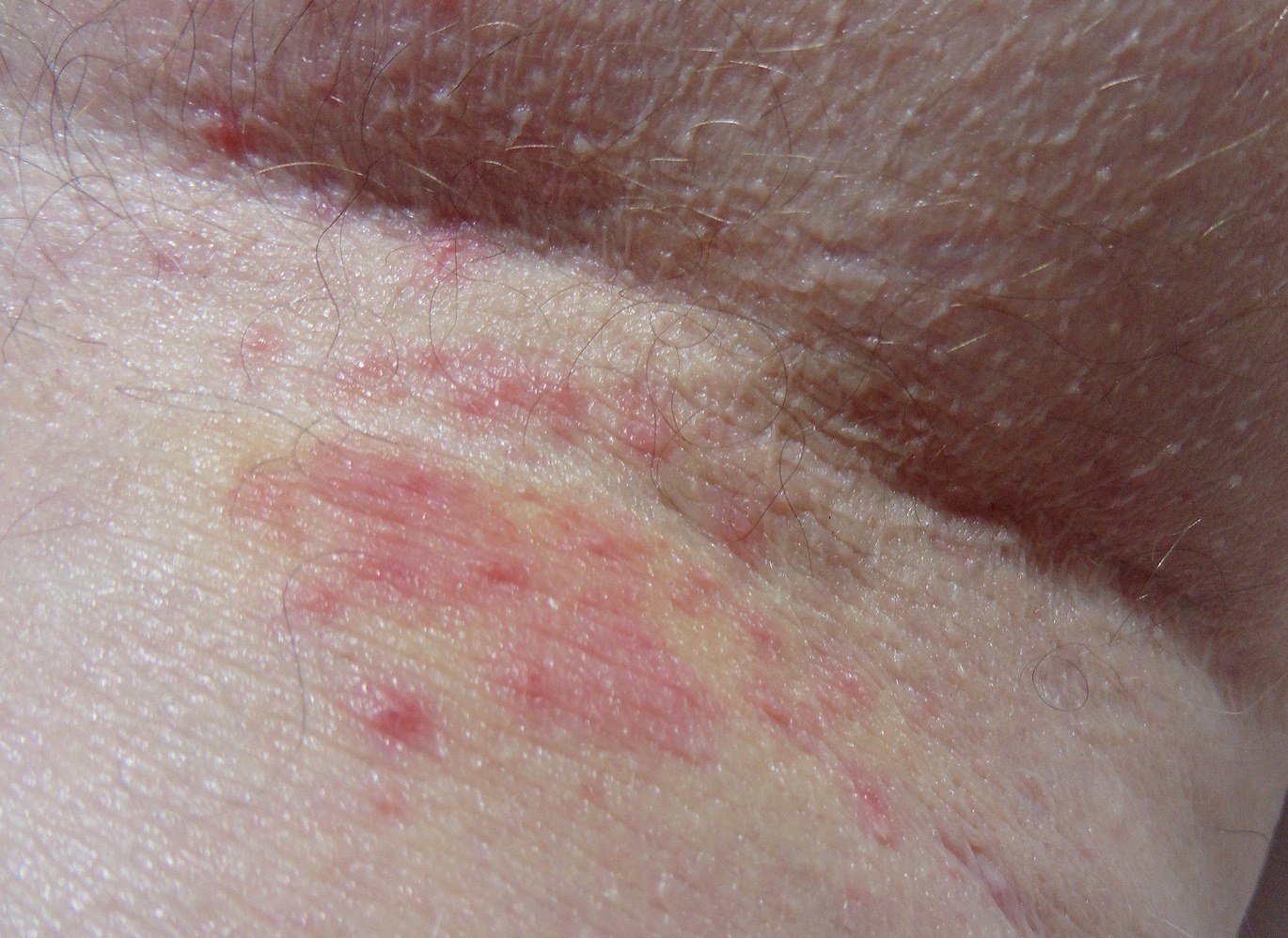 sore arm