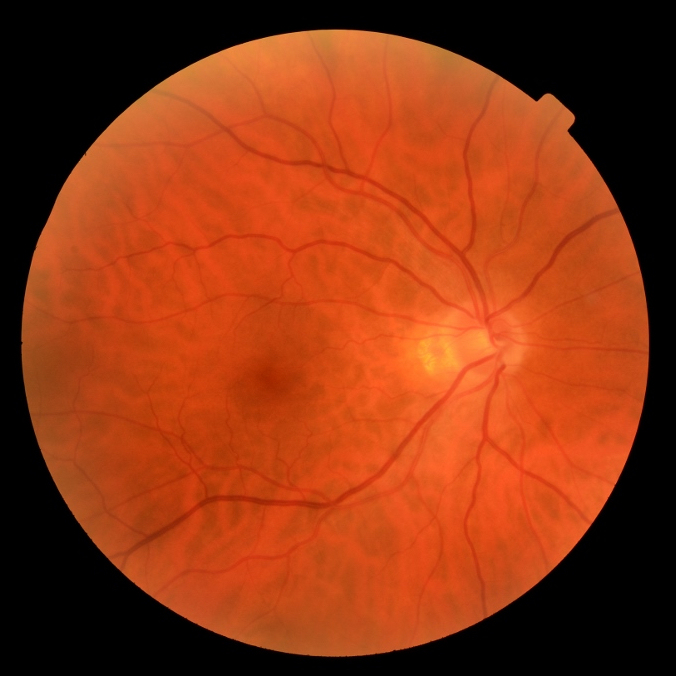 retina